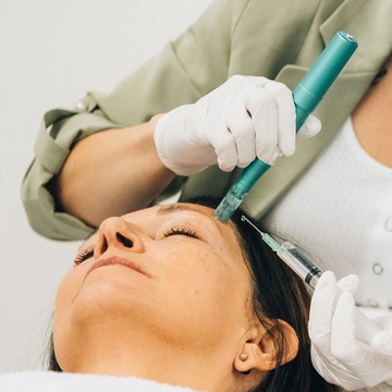 Matrixneedling Needling